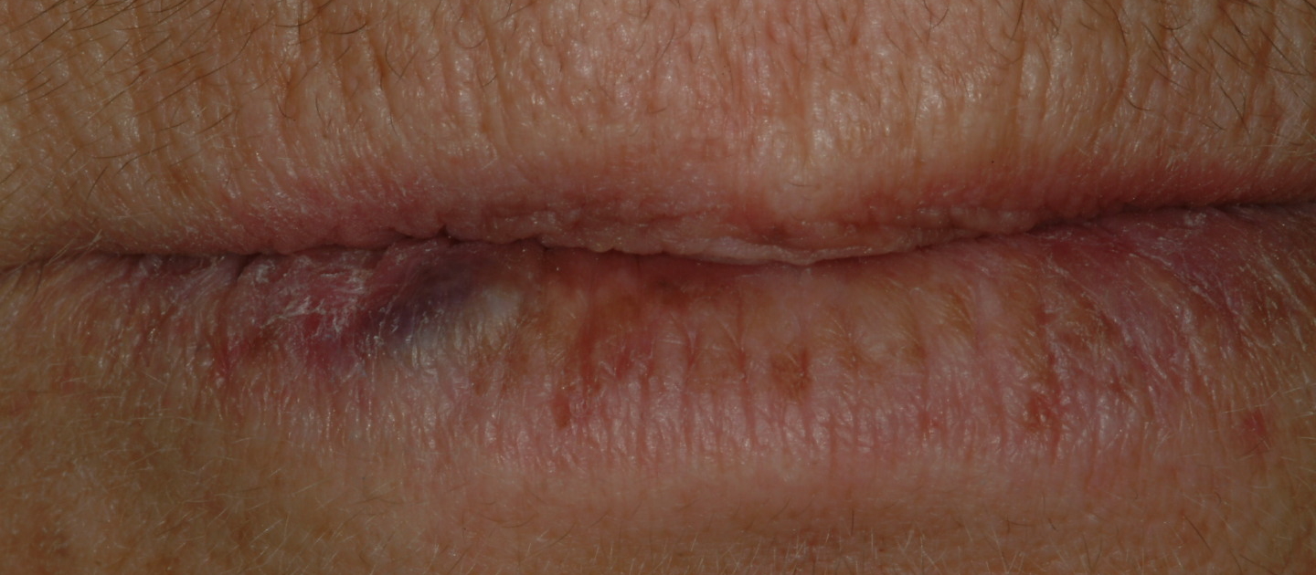 ANGIOMA DEL LABBRO