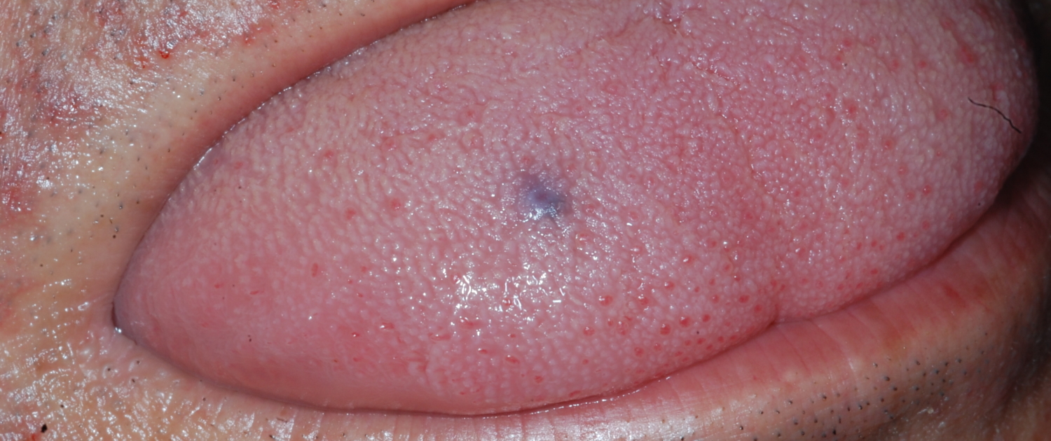 LESIONE SOSPETTA MUCOSA DORSO LINGUA