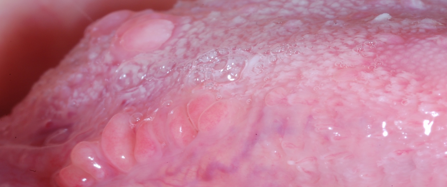 NEOFORMAZIONI BENIGNE MUCOSA DEL MARGINE DELLA LINGUA
