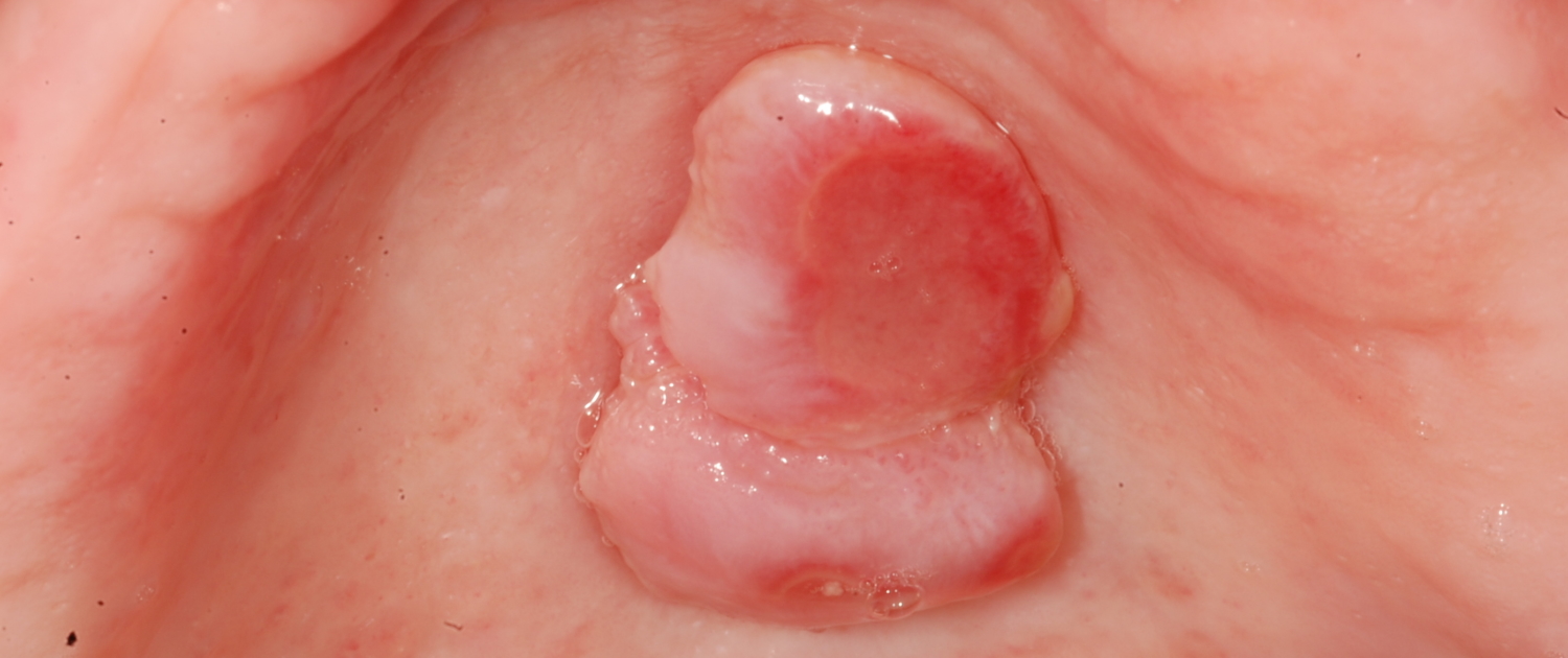 PAPILLOMA DEL PALATO
