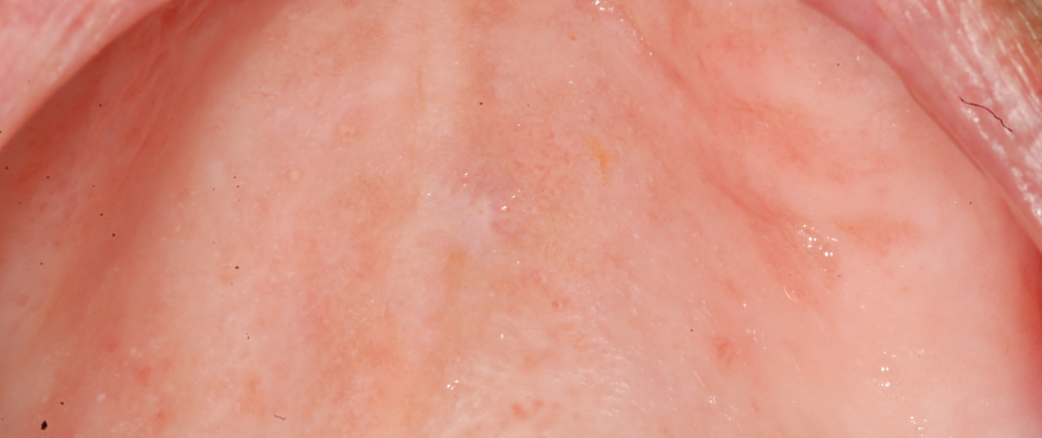 GUARIGIONE DEL PALATO DOPO RIMOZIONE DEL PAPILLOMA