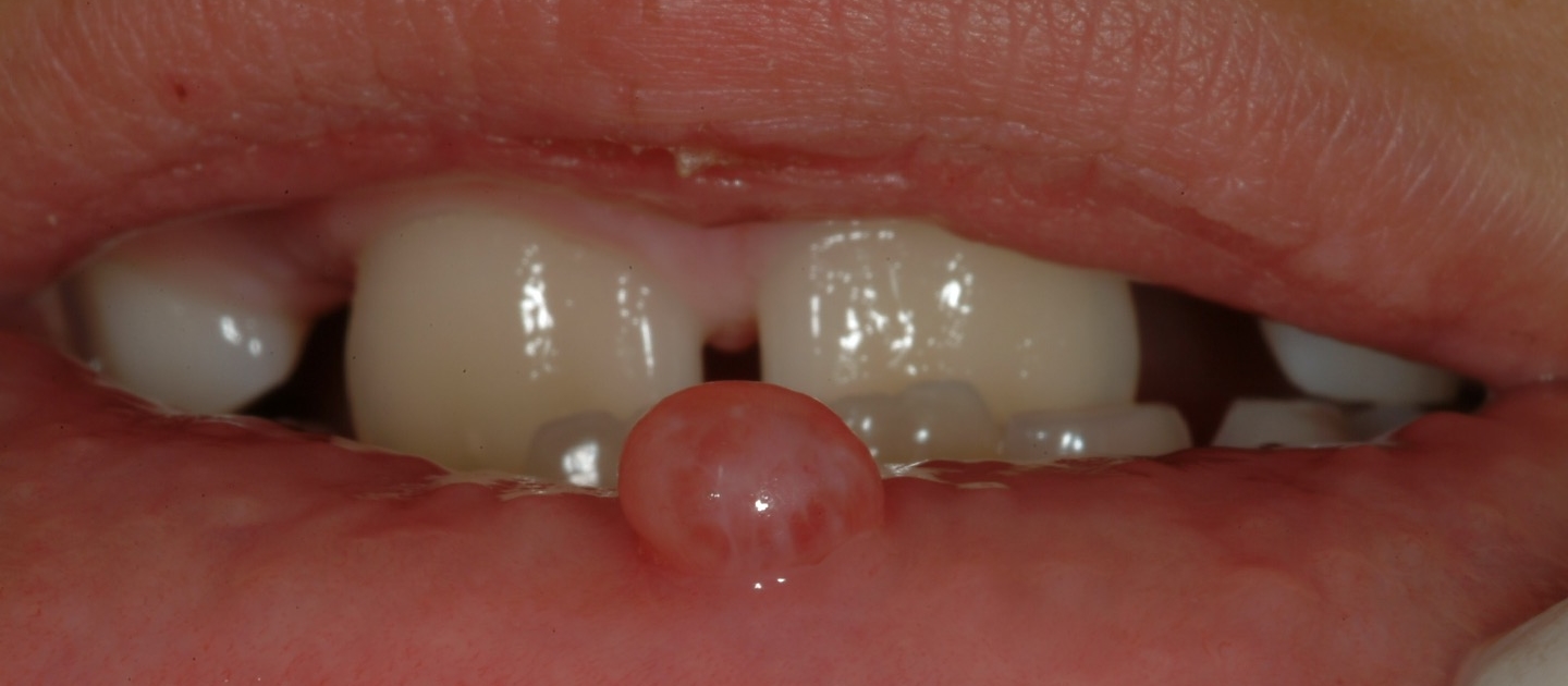 MUCOCELE