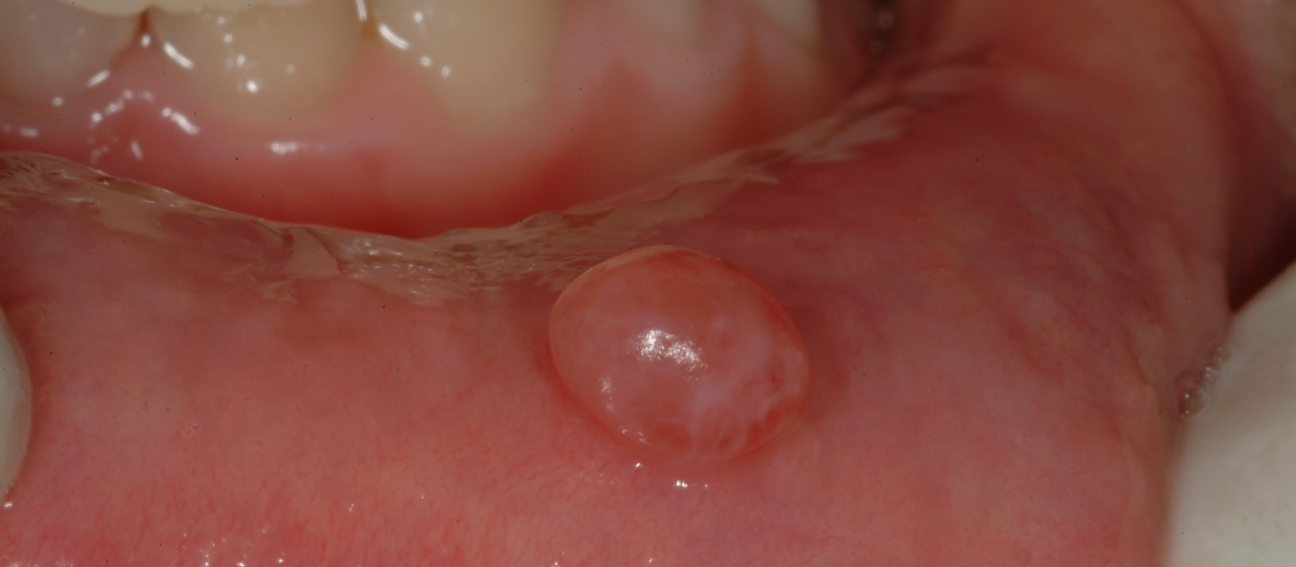MUCOCELE - DETTAGLIO
