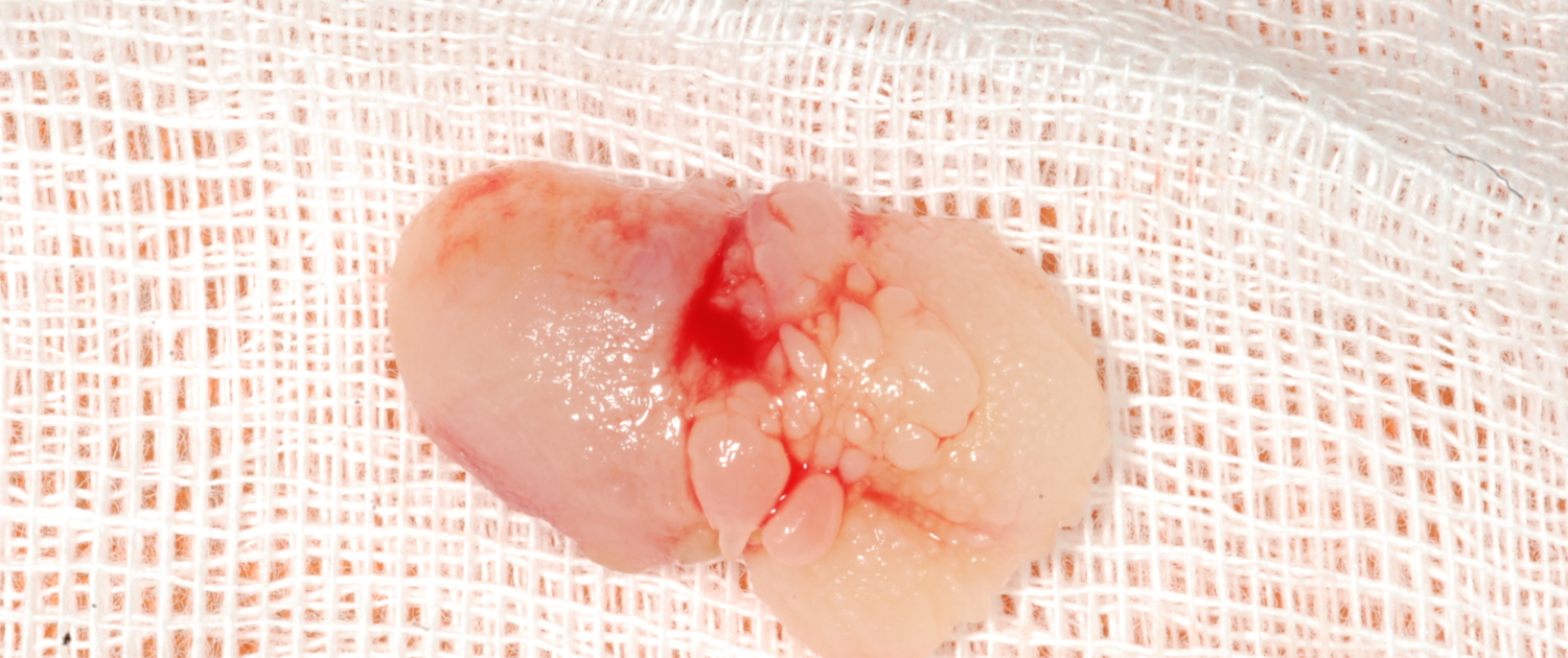 PAPILLOMA PALATALE POST INTERVENTO